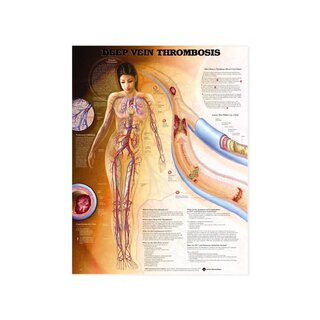 Dziļo vēnu tromboze (DVT) - plakāts