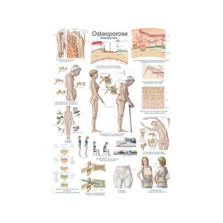 Plakāts Osteoporoze - Anatomiskais plakāts 50x70cm