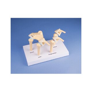 4. stadijas osteoartrīta (OA) pleca modelis